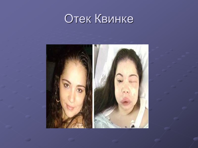 Отек Квинке